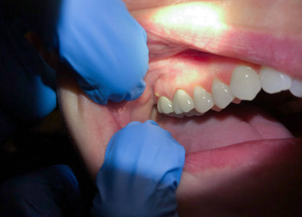 Best Emergency Dental Care for Abscessed Tooth in Forest, VA